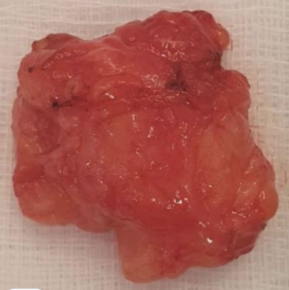 Paniculosis fluid