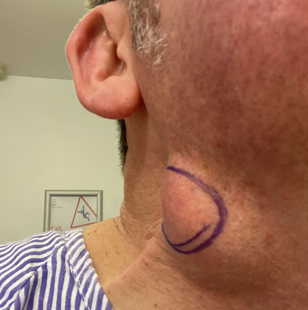 Surgery to remove paniculosis