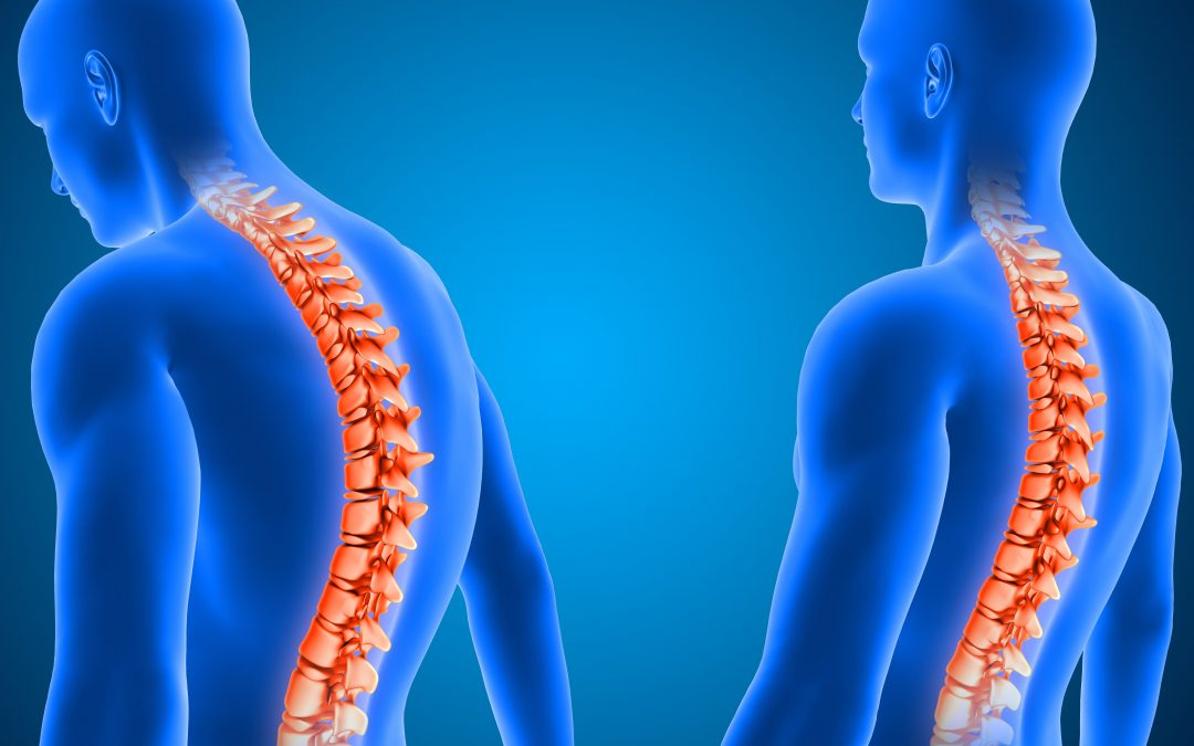 Posture Article in the Guardian featuring Tim King and the CiONE Wellness Centre