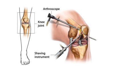 Bio Fascial Release For Knee Pain